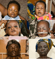 67 CLEFT-LIP AND PALATE DEFORMITY VICTIMS GET SUCCOUR IN ABEOKUTA