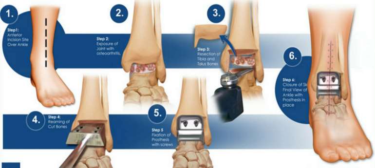 Ankle Replacement Surgery